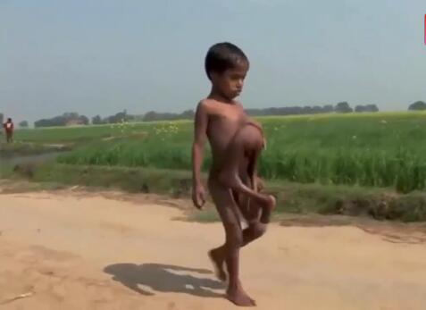 世界上4只手的人 印度一小男孩竟长有4只手4只脚(图)